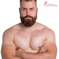 Cirugía de ginecomastia en México para mejorar la confianza en el pecho masculino y la imagen corporal